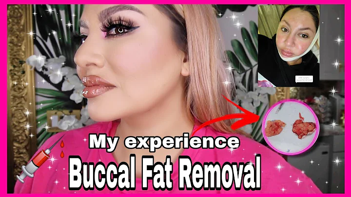 SURGERY VLOG| #BUCCALFAT REMOVAL IN TIJUANA| MY EX...