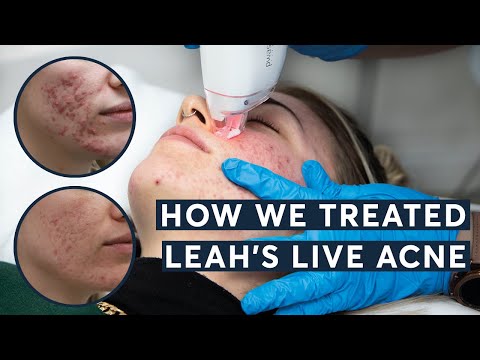 How did we treat Leah's Live Acne?