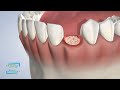 Post-Operative Instructions: Bone Grafting in Fresno CA | Fresno Oral Maxillofacial Surgery