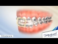 Corrección de mordida y espacios dentales "Ortodoncia"