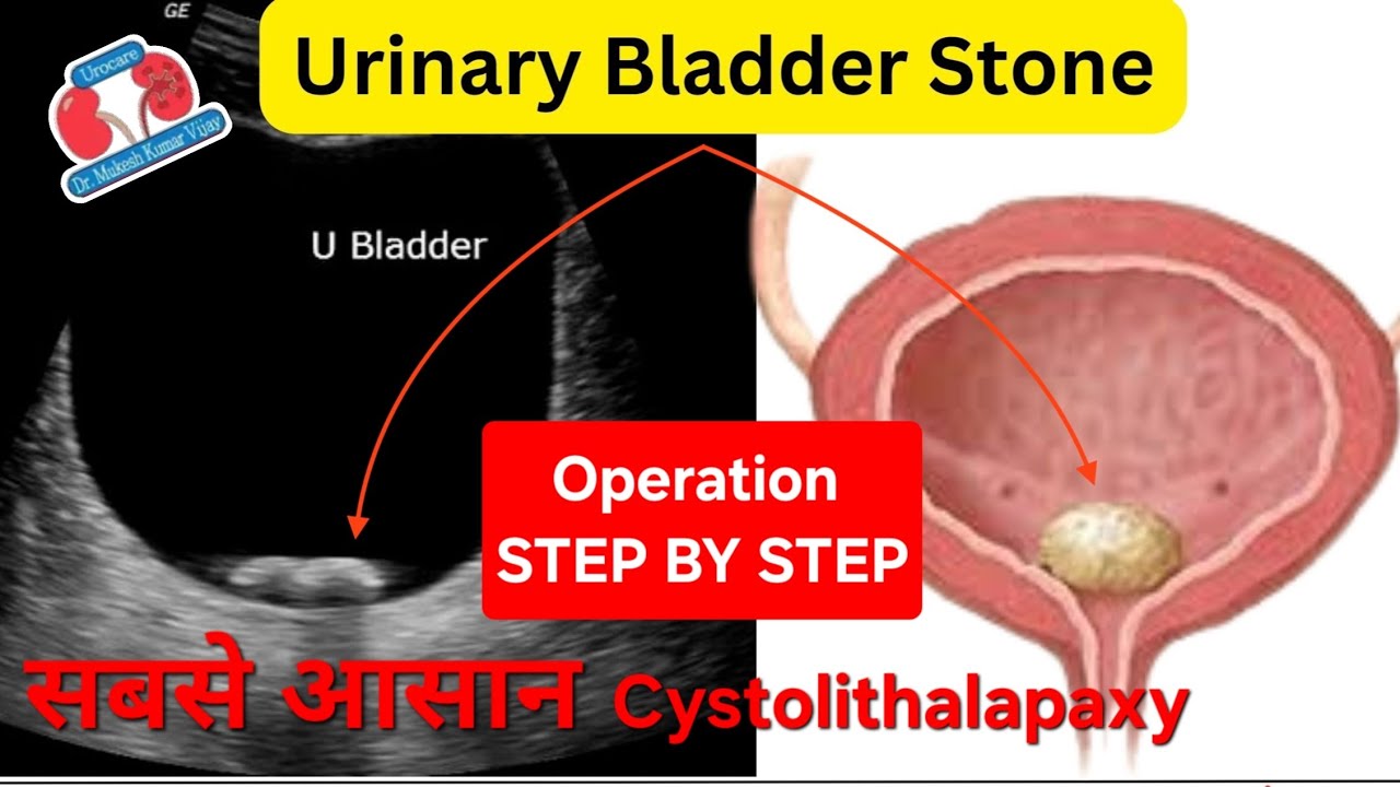 Bladder Stone तुरन्त हटेगा? Bladder Stone Removal: Step-by-Step ...