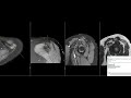 Radiologist at work - 10 MSK MRI in under 80min - LIVE reporting session [GERMAN]