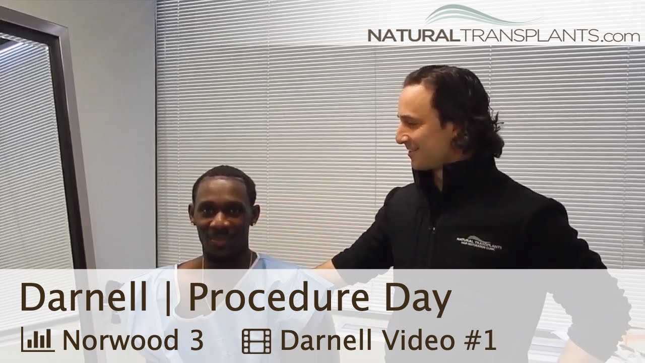 fue hair transplant month by month Hair Loss Treatment for Black Men | Hair Loss Treatment 2019 (Darnell)