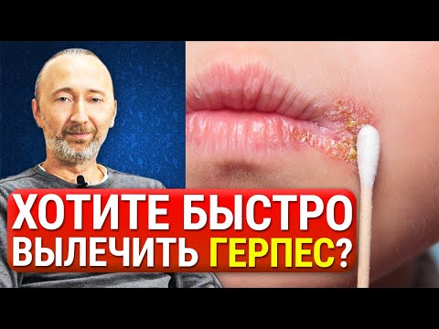 ГЕРПЕС. Как быстро и легко избавиться от герпеса? САМЫЕ эффективные и натуральные методы лечения!