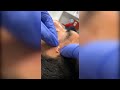 Popping huge blackheads and giant pimples  best pimple poppings 125