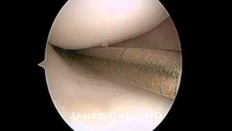 Irreparable Bucket Handle Meniscus Tear of the Knee