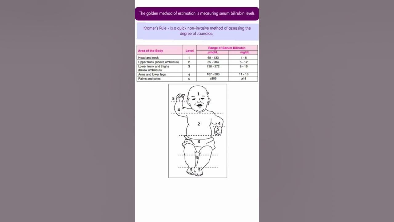 Kramer's rule Evaluating jaundice of new born infant ShortNursing