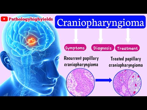 Craniopharyngioma-high yields.3 Worst signs and Symptoms of Craniopharyngioma-usmle,neetpg,plab,fmge