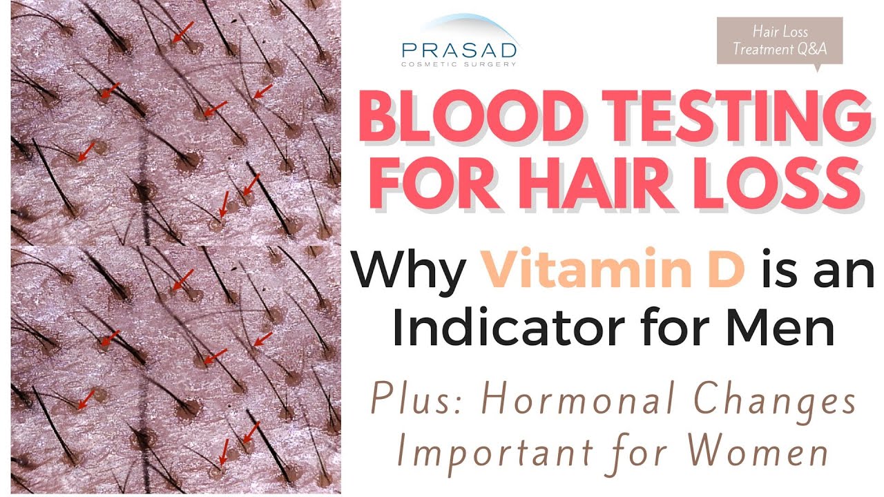 Testing For Hair Loss Importance Of Vitamin D And Why