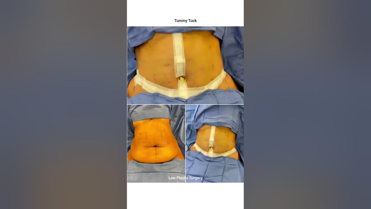 tummy-tuck-the-fleur-de-lis-resection-gives-more-control-in-that