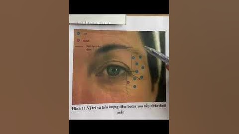 Cách xác định điểm tiêm xoá nhăn đuôi mắt phù hợp với từng tình trạng nhăn của khách hàng.