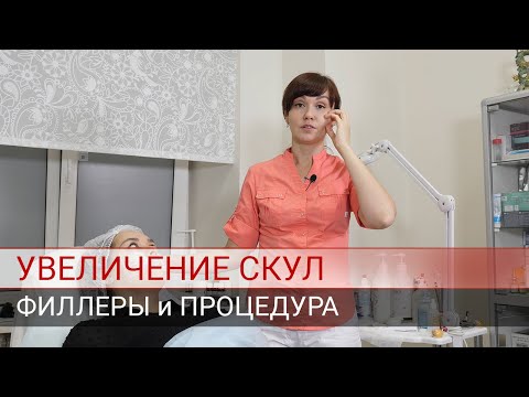 Увеличение скул филлерами.