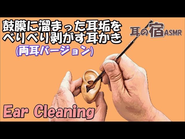 【ASMR】鼓膜に溜まった耳垢をべりべり剥がす耳かき(両耳バージョン)【Ear cleaning】