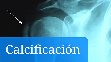 ¿Qué causa la calcificación de los nervios de los dientes?