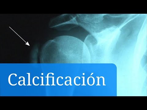 Vídeo: Acumulació De Calci En Pulmons De Gats