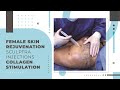 Female Skin Rejuvenation | Sculptra Injections | Collagen Stimulation