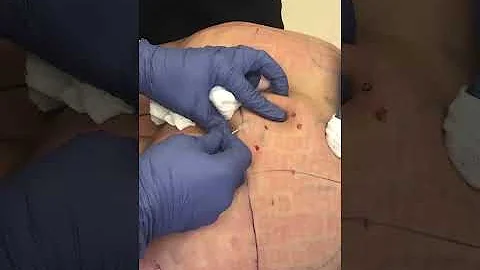 Female Skin Rejuvenation | Sculptra Injections | Collagen Stimulation - DayDayNews