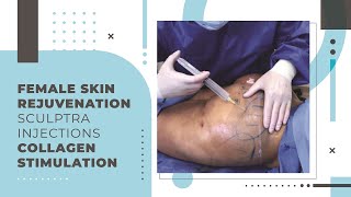 Female Skin Rejuvenation Sculptra Injections Collagen Stimulation