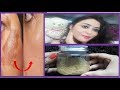 1 पैसा भी खर्च नही हुआ झाइयों से मिला छुटकारा Get Rid of pigmentation, Freckles, Dark Spots, Melasma