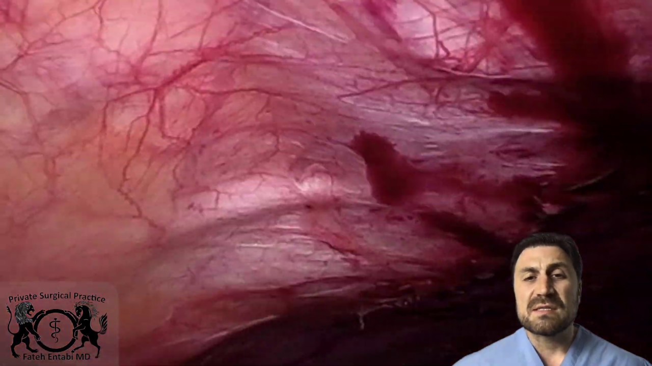 Laparoscopic Lysis of adhesionsScar tissue removal YouTube