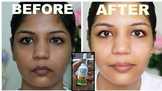 चेहरे की खराब काली परत ऐसे हटेगी जैसे कभी थी नहीं  | #gorakarnewalicream, #Facecream, #clearskin