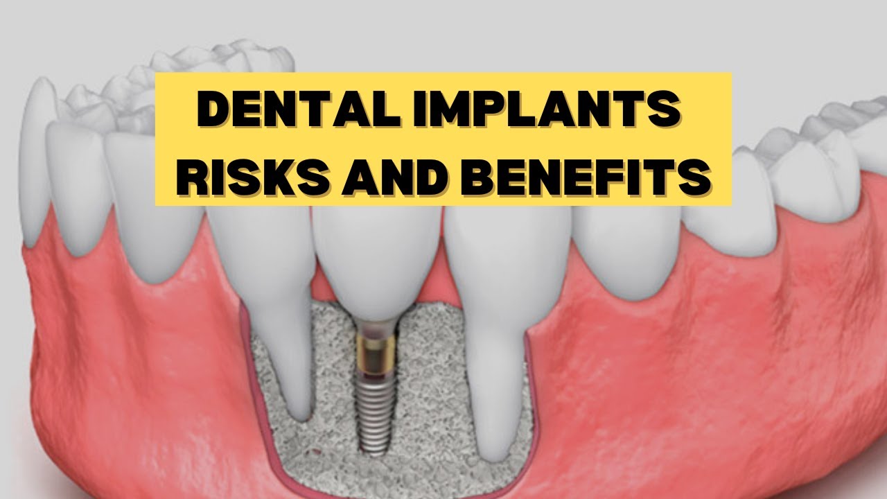 Dental Implants | Types, Benefits, and Risks