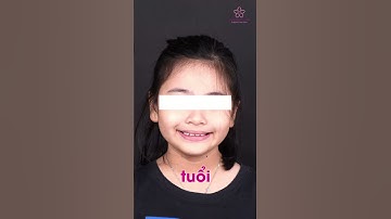 KHỚP CẮN SÂU | NGUYÊN NHÂN TỪ ĐÂU?