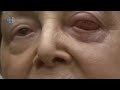 Blind patient sees again with eye tooth