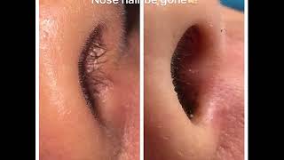 laser hair removal nose hair