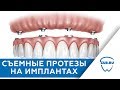 Съемные протезы на имплантах