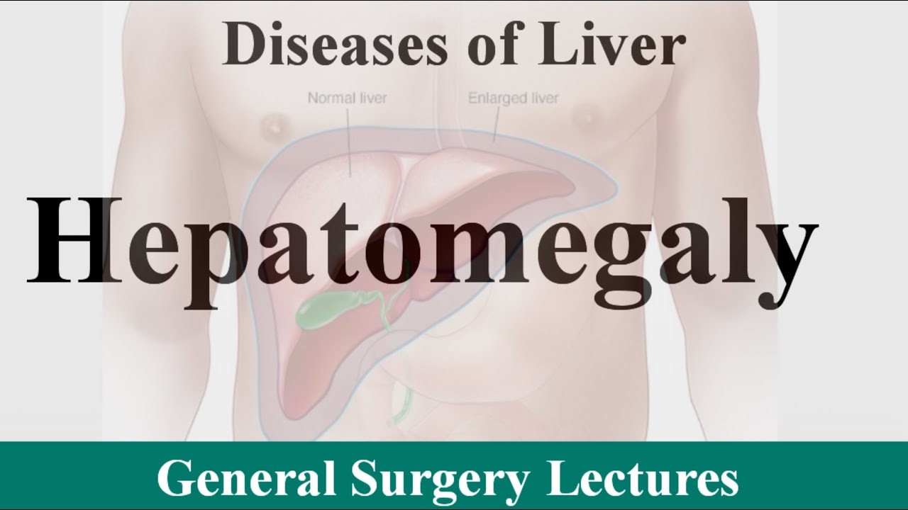 Hepatomegaly In Hindi Diseases Of Liver General Surgery hepatomegaly-in-hindi-diseases-of-liver-general-surgery