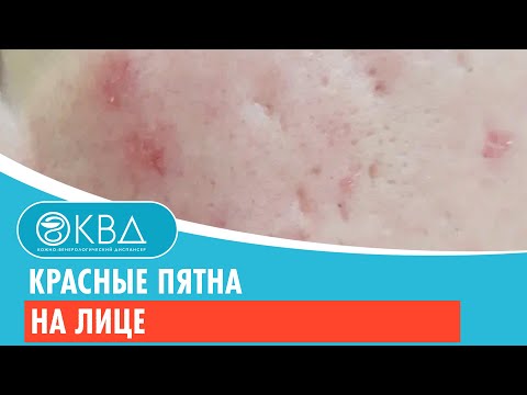 😩 Красные пятна на лице. Клинический случай №334