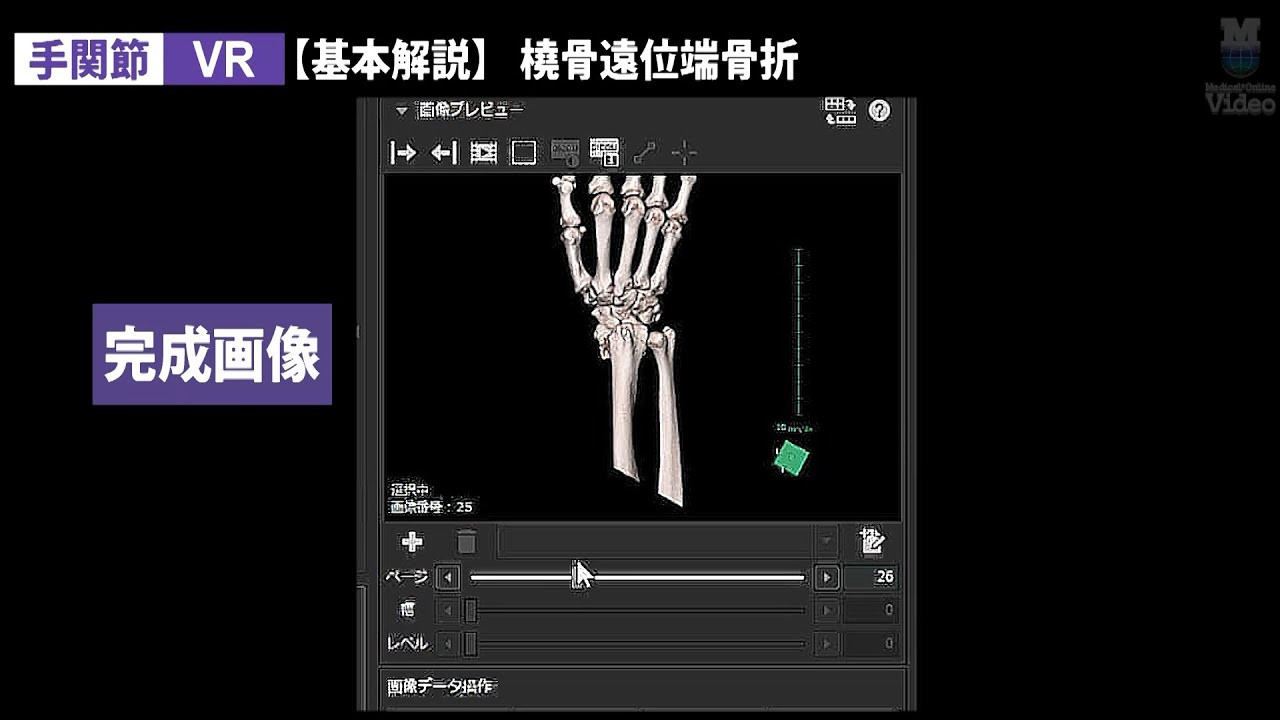3D画像製作 手指骨・手関節（舟状骨） MPR・VR ｜ 3D画像作成（CT） 整形外科領域 ｜ Medical*Online Video ...