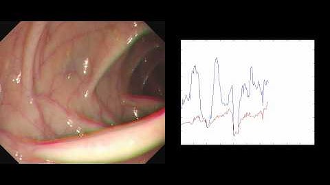 ENDOVIEW: Measuring Quality  of  Endoscopy