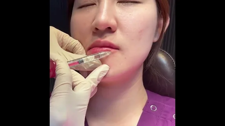 想要擁有好看又適合自己的唇型，可以透過注射玻尿酸來達成！#shorts - 天天要聞