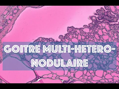 LE GOITRE MULTI-HETERO-NODULAIRE - PATHOLOGIE