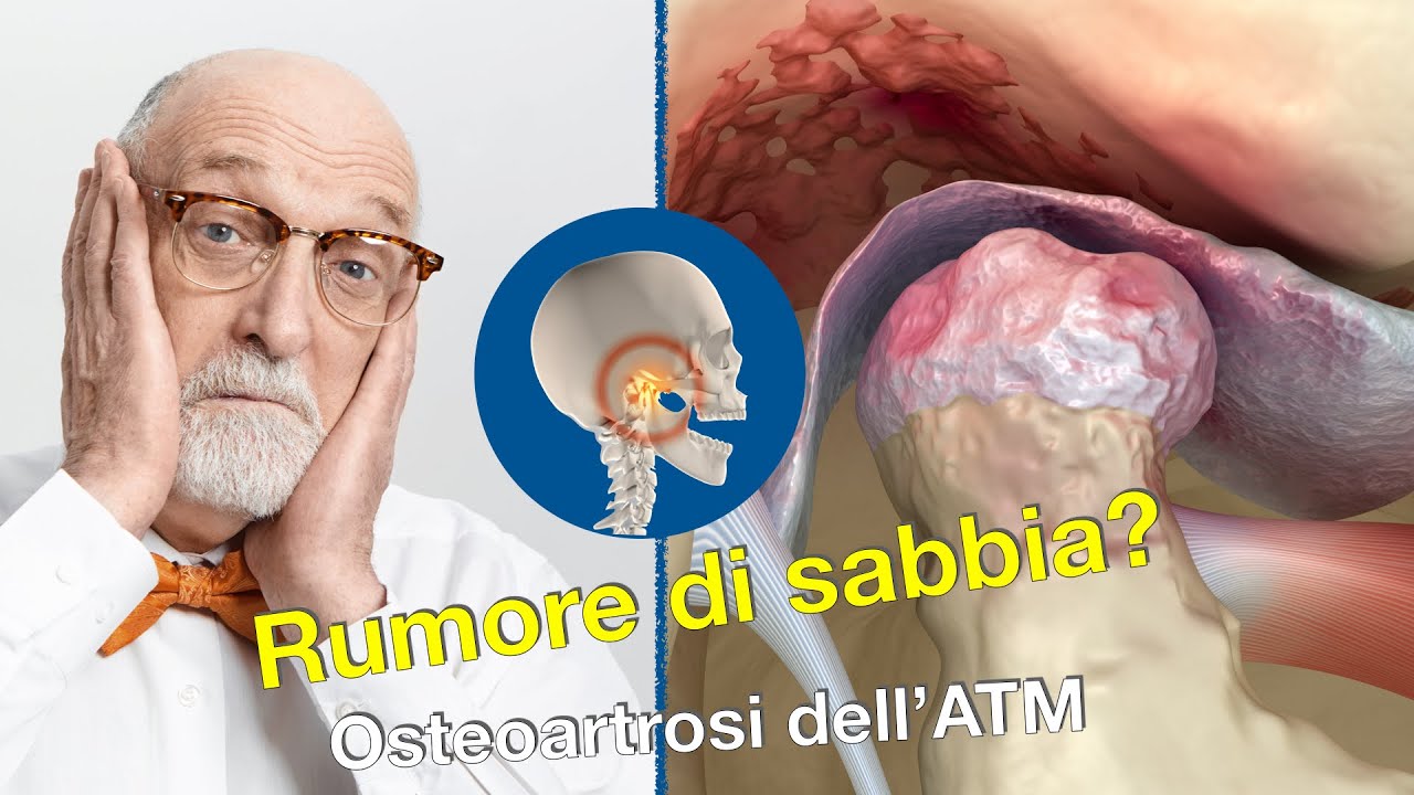 Rumore di sabbia? - Osteoartrosi dell'ATM.