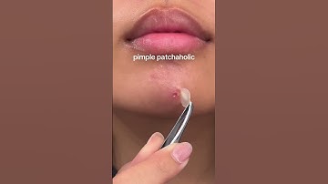 just call me a pimple patchaholic #pimplepatch #acneproneskin #pimples #sosatisfying