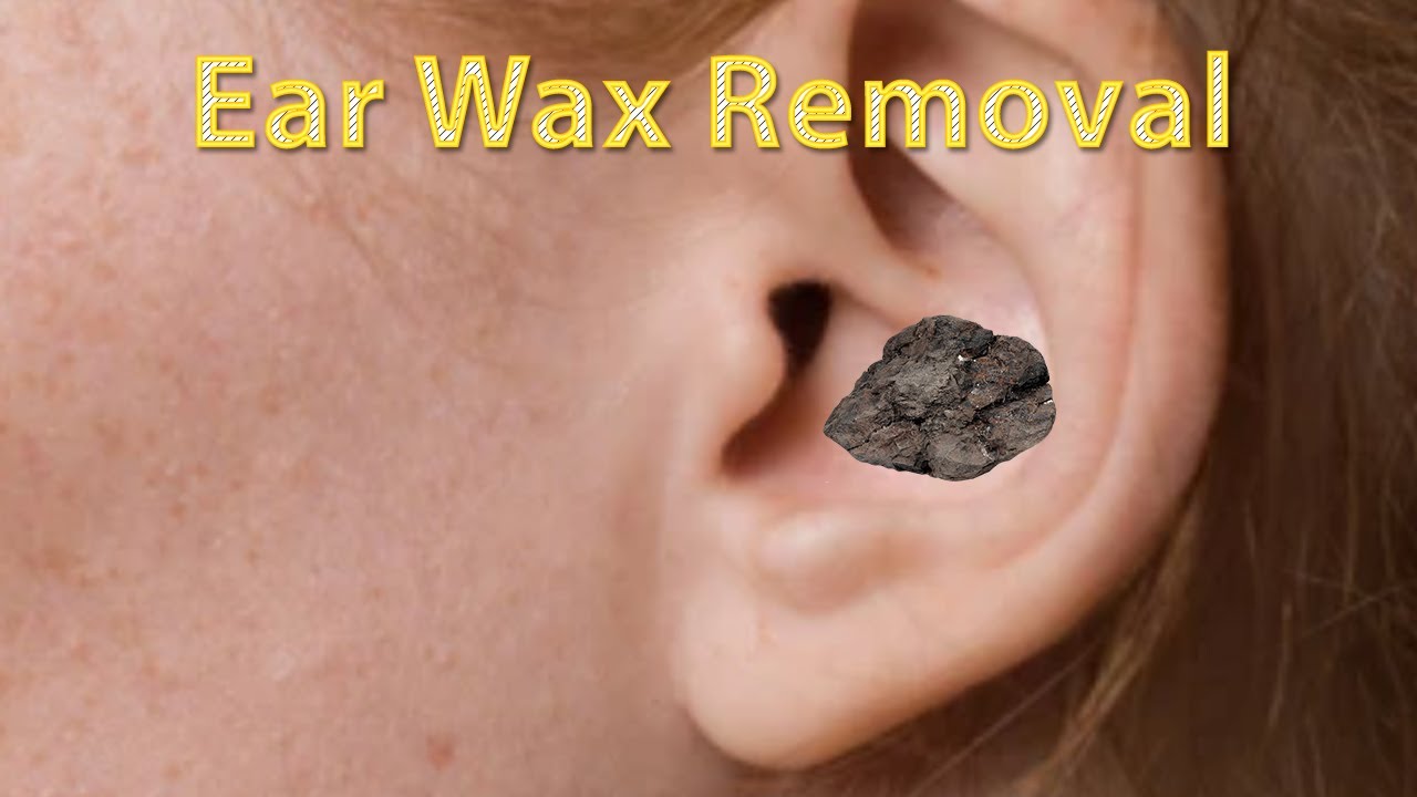 Large Ear Wax Removal! Biggest Ear Wax Removal! Cerumen YouTube