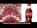 5 MINUTOS PARA DESCALCIFICAR TARTARO COMPLETAMENTE DOS DENTES USANDO COCA COLA