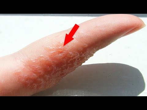 If You See These Painful Red Bumps, You Might Have This Skin Condition