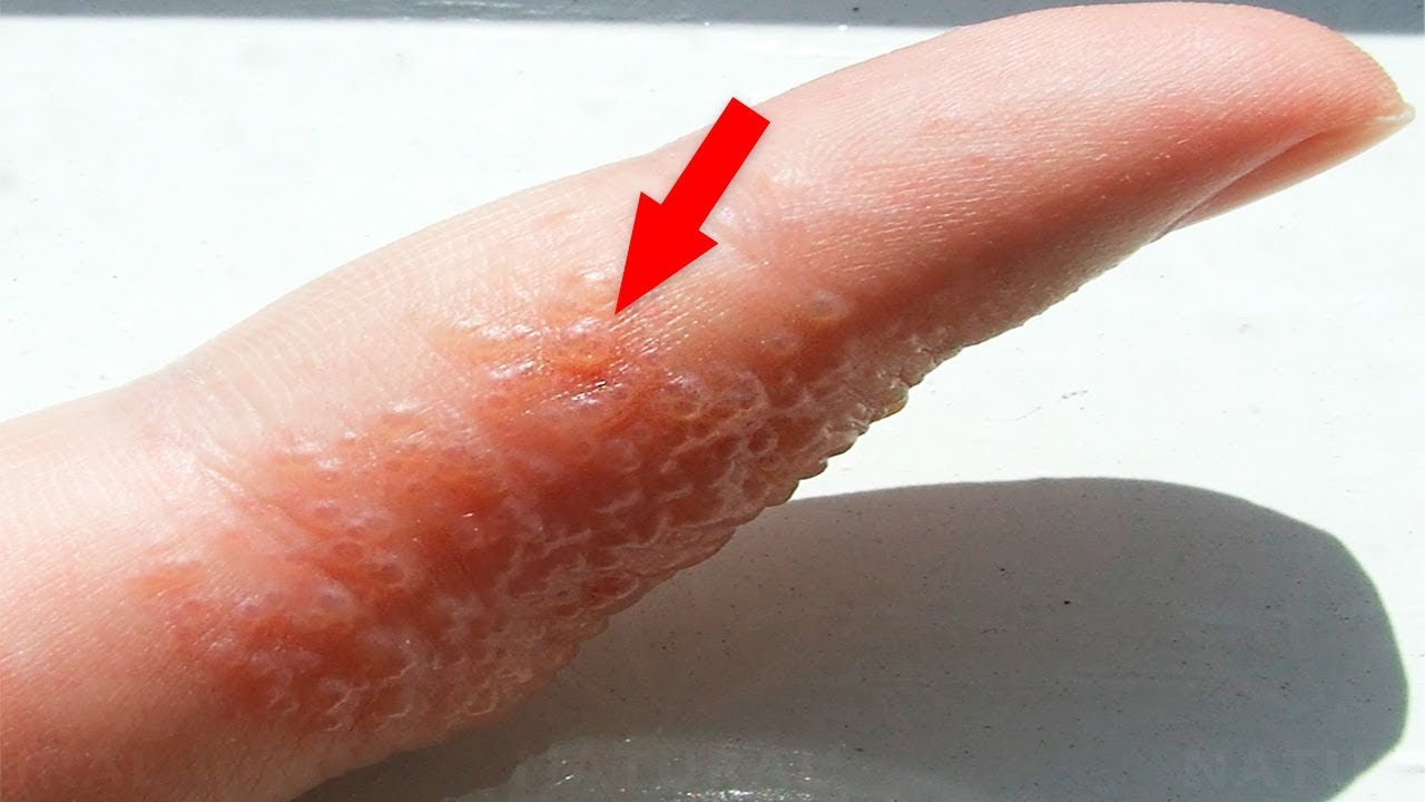 If You See These Painful Red Bumps You Might Have This Skin Condition