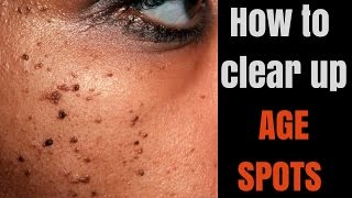 How to get clearer complexion for your skin