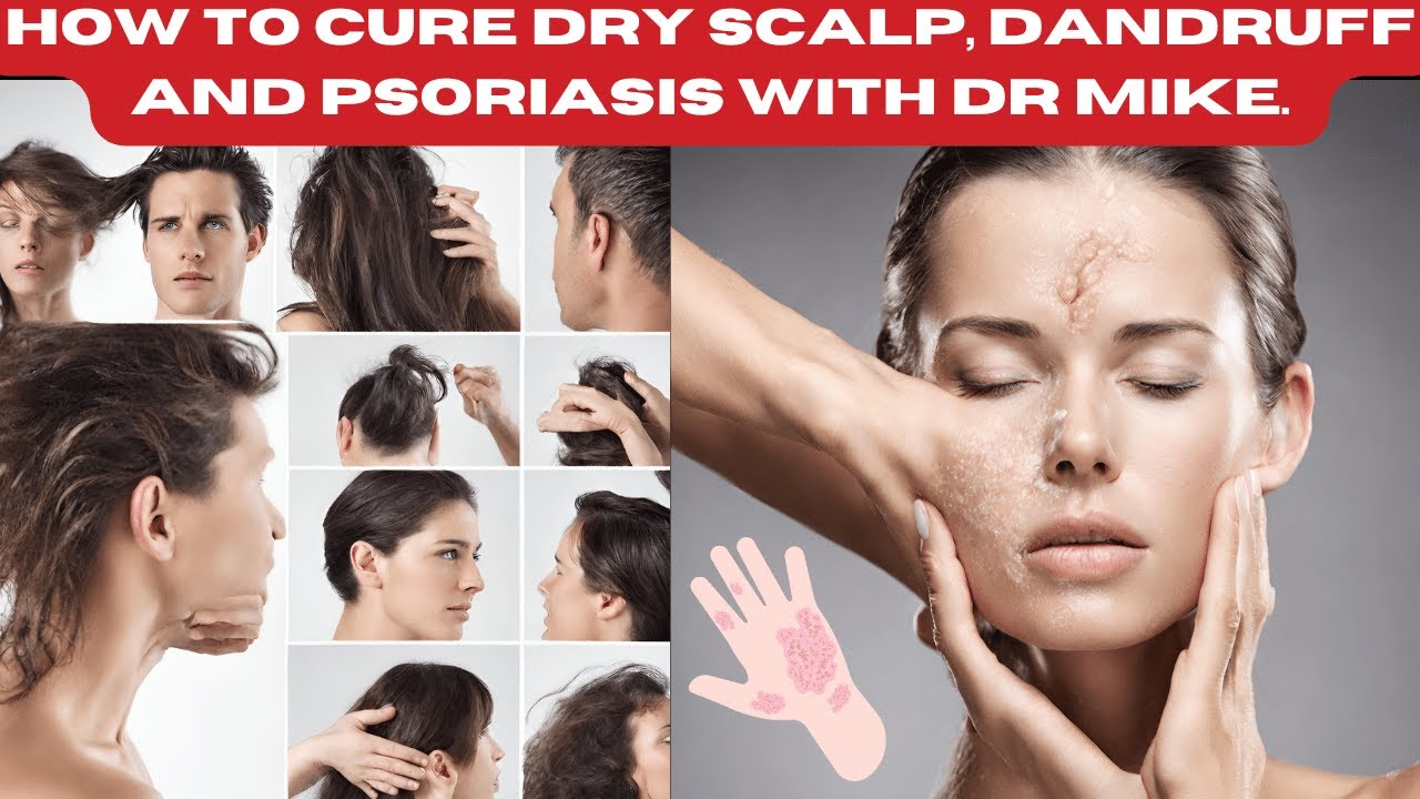 How To Cure Dry Scalp, Dandruff And Psoriasis With Dr Mike. - YouTube
