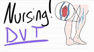 DVT - Nursing Risk Factors, Symptoms, Complications, Diagnostics, Treatment