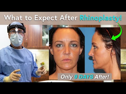 What Can I Expect During Rhinoplasty Recovery? One Day to Three Weeks Post-Op