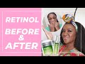 Retinol BEFORE and AFTER: 6 Week Murad Retinol Serum Vlog Diary | Skincare Squad