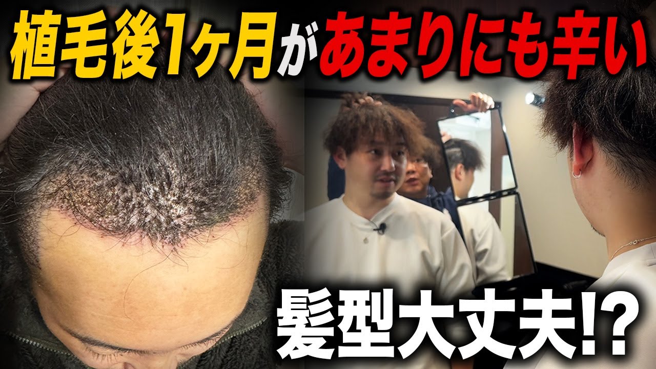 One month after hair transplant] The most difficult time is the