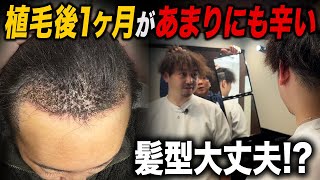 One month after hair transplant] The most difficult time is the