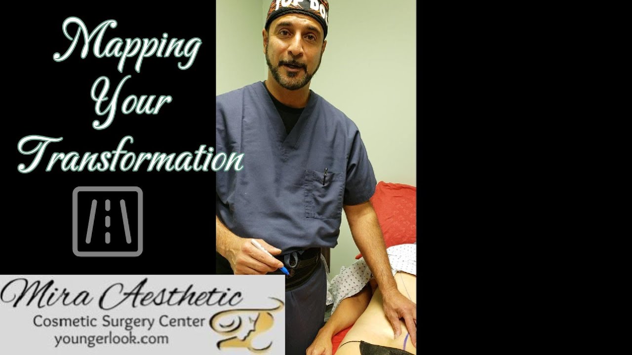 Step by Step Tummy Tuck Drawing Visual Guide to the Procedure - YouTube